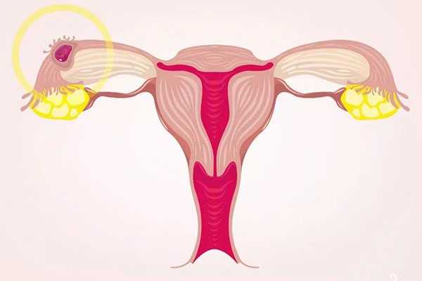 输卵管出现这些问题，可能会影响怀孕!